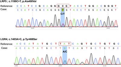 Case report: exome sequencing identified mutations in the LRP5 and LGR4 genes in a case of osteoporosis with recurrent fractures and extraskeletal manifestations